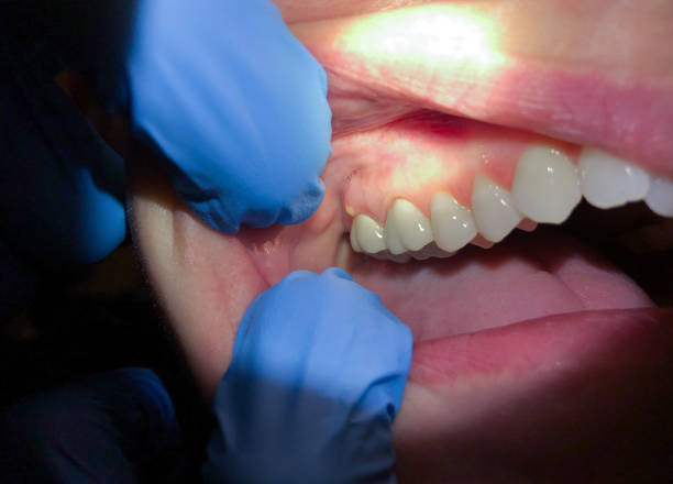 Best Tooth Infection Emergency Dentist  in Plymouth Meeting, PA